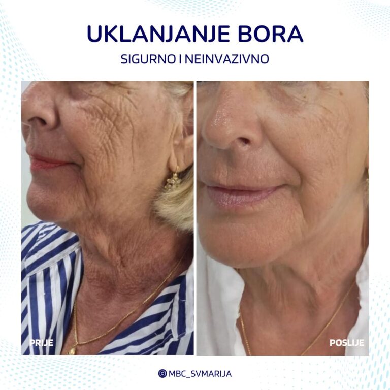 uklanjanje bora Split, zatezanje lica Zadar, anti-age tretmani Split, cijena zatezanja lica Zadar, estetski zahvati protiv bora Split, klinike za zatezanje lica u Zadru, dermatološki tretmani protiv bora Split, lasersko zatezanje lica Zadar, recenzije anti-age tretmana Split, kozmetički salon zatezanje lica Zadar, anti-age terapije Split, kirurgija protiv bora Zadar, prije i poslije zatezanja lica Split, najbolji anti-age tretmani Zadar, injekcije protiv bora Split, cijene anti-age tretmana Zadar, medicinski tretmani protiv bora Split, prirodni anti-age tretmani Zadar, savjeti za zatezanje lica Split, plastična kirurgija protiv bora Zadar.