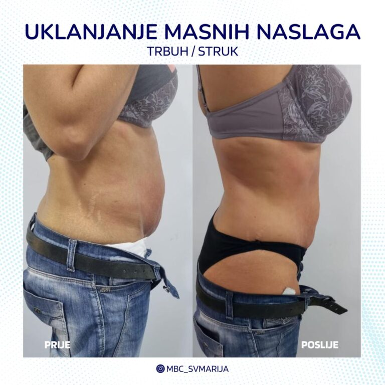 uklanjanje masnih naslaga Split, liposukcija Zadar, tretman za mršavljenje Split, cijena liposukcije Zadar, estetski zahvati masne naslage Split, klinike za liposukciju u Zadru, nekirurško uklanjanje masnoća Split, lasersko uklanjanje masnih naslaga Zadar, recenzije liposukcije Split, kozmetički salon mršavljenje Zadar, body contouring tretmani Split, kirurgija masnih naslaga Zadar, prije i poslije uklanjanja masnih naslaga Split, najbolji tretmani za mršavljenje Zadar, injekcije za razbijanje masnoća Split, cijene tretmana masnih naslaga Zadar, medicinski tretmani za masne naslage Split, prirodno uklanjanje masnih naslaga Zadar, savjeti za uklanjanje masnih naslaga Split, kavitacija tretmani Zadar.